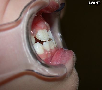 maxillaire-mandibule-5