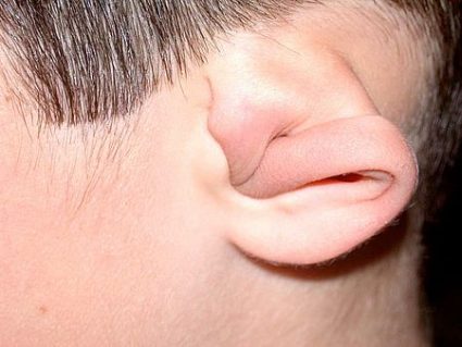 probleme-oreille-neuroposturophonie-ok